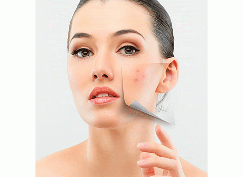 Resultado de imagen para piel con acne